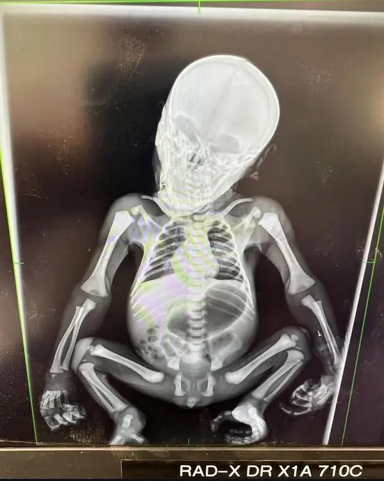 تصویر اشعه ایکس اسکلت یک پریمات در حالت جنینی، با جمجمه، قفسه سینه و اندام‌ها قابل مشاهده.